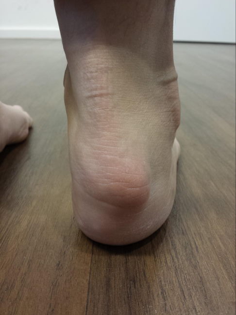 Patient mit Haglundferse rechts. Deutlich sieht man die Vorwölbung des Fersenbeins mit Rötung. © Gelenk-Klinik Patient mit Haglundexostose