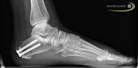 Röntgenbild nach Umstellungsoperation: Bis zur kompletten Ausheilung wird die korrigierte Position des Fersenbeins mit Schrauben fixiert. © Dr. med. Thomas Schneider Patient nach Umstellungsoperation