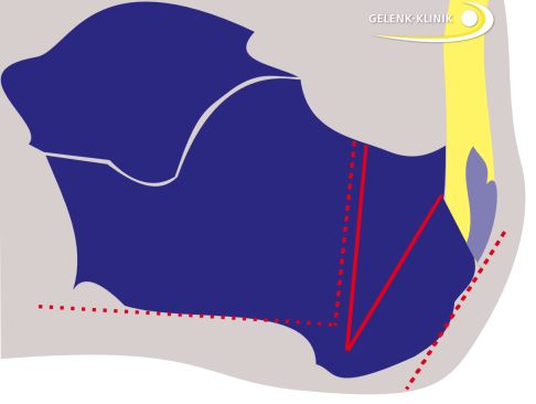 Bei der Zadek-Operation entfernt der Operateur einen Keil aus dem Fersenbein (rote Linie). Ziel ist, die gestrichelten Linien parallel auszurichten. © Dr. med. Thomas Schneider Patient mit Haglundexostose