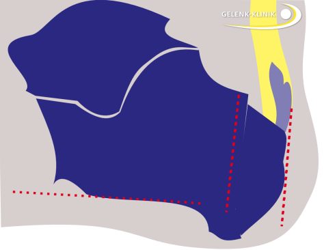 Die Keilentfernung korrigiert die Stellung des Fußes insgesamt und führt zur Druckentlastung am Achillessehnenansatz. Die Position wird mit Schrauben fixiert. © Dr. med. Thomas Schneider Patient mit Haglundexostose