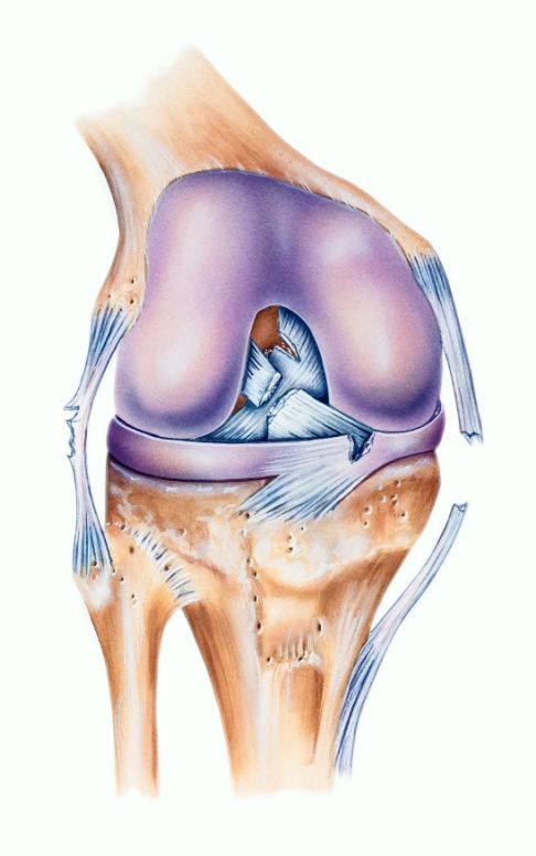 Deutlich sichtbar ist das verletzte vordere Kreuzband in der Bildmitte. Verletzungen der Seitenbänder im Kniegelenk können einen Kreuzbandriss begleiten. © Istockphoto.com/MedicalArtInc Ruptur der Kreuzbänder im Kniegelenk