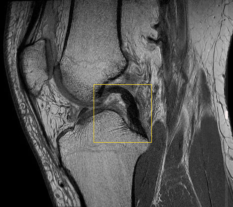 Kernspintomografie: Das hintere Kreuzband verläuft intakt von der Vorderseite des Oberschenkels bis zur hinteren Gelenkfläche des Schienbeines. © Radiopedia.org Intaktes hinteres Kreuzband im MRT (Magnetresonanztomografie)