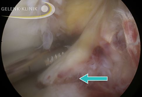 Arthroskopisches Bild des Kniegelenks: frische Verletzung des vorderen Kreuzbandes mit knöchernem Ausriss. Ohne Kreuzbandplastik (Kreuzbandersatz) heilt ein Kreuzbandriss nicht aus. © Gelenk-Klinik.de Frische Kreuzbandverletzung