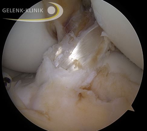 Das Sehnentransplantat wurde im Knochenkanal verankert. Es übernimmt nun die Funktion des vorderen Kreuzbandes. © Gelenk-Klinik Kreuzbandplastik im Knochen verankert
