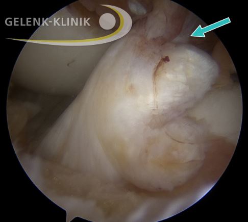 Arthroskopisches Bild: femoraler (oberschenkelseitiger) Abriss des vorderen Kreuzbandes. © Gelenk-Klinik Kreuzbandschaden in der arthroskopischen Darstellung