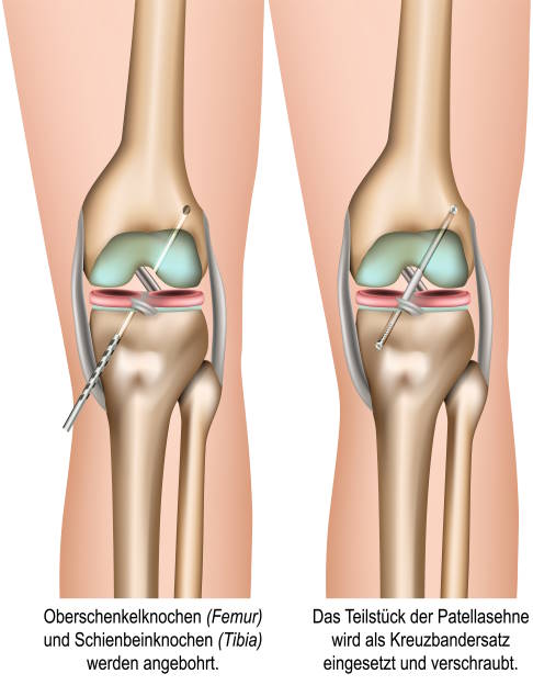 Vorbereiten des Knochens und Einsatz des Sehnentransplantats. © bilderzwerg, Adobe Kreuzbandriss OP: Vorbereitung des Knochens und Einsatz des Transplantats