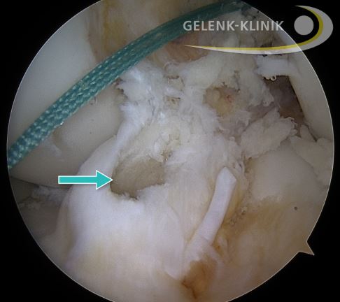 Bohrkanal im Schienbein (Tibia): Der Kreuzbandersatz wird anstelle des gerissenen Kreuzbandes im Knochen verankert. © Gelenk-Klinik.de tibialer (im Schienbein liegender) Bohrkanal zur Befestigung des Transplantates