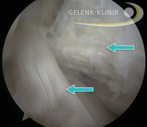 Arthroskopie: Das vordere und hintere Kreuzband des Knies sind in diesem Bild intakt. © Gelenk-Klinik Kniegelenk: vorderes und hinteres Kreuzband