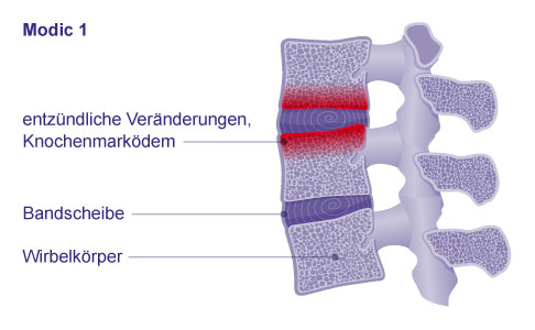 Die Klassifikation der Osteochondrose intervertebralis erfolgt anhand der Einteilung nach Modic. Bei Modic 1 zeigen sich Entzündungen und Flüssigkeitsansammlungen im Knochen. © Gelenk-Klinik Klassifikation der Osteochondrose intervertebralis: Modic Typ 1