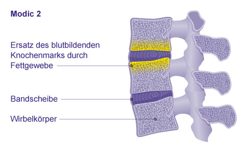 Bei Modic 2 baut sich der Knochen langsam ab und Fettgewebe ersetzt das Knochenmark. © Gelenk-Klinik Klassifikation der Osteochondrose intervertebralis: Modic Typ 2