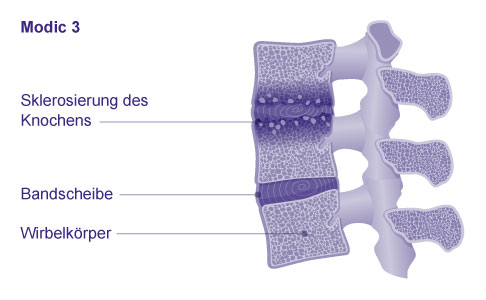 Bei einer nach Modic 3 veränderten Wirbelsäule verhärten die Wirbelkörper und es können sich knöcherne Anbauten (Spondylophyten) bilden. Diese beschränken die Beweglichkeit der Wirbelsäule. © Gelenk-Klinik Klassifikation der Osteochondrose intervertebralis: Modic Typ 3