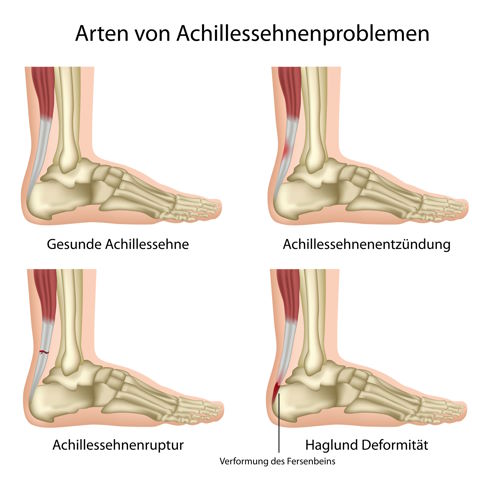Reizzustände der Achillessehne können langfristig einen Achillessehnenriss begünstigen. © bilderzwerg, Adobe Erkrankungen der Achillessehne