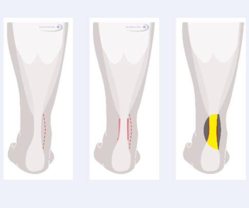 Behandlung der Achillessehnenhülle: Nach Hautschnitt und Aufsuchen der Sehne von der Seite des Innenknöchels her löst der Operateur Verklebungen und Narben und entfernt entzündete Hüllenbereiche. © Gelenk-Klinik Behandlung der Sehnenhülle der Achillessehne in drei Schritten