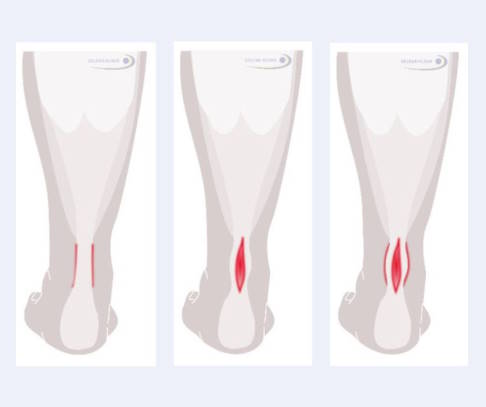 Links: Peritendinitis. Mitte: isolierte Tendinosis. Rechts: Peritendinitis mit Tendinosis. © Gelenk-Klinik Grafische Darstellung in drei Bildern: Peritendinitis, isolierte Tendinosis und Peritendinitis mit Tendinosis.