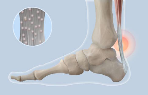 Sehnenreizungen (Tendinopathien) entstehen aufgrund wiederholter Fehlbelastungen. © VISUALPOINT, Adobe Fuß mit geschädigter Achillessehne