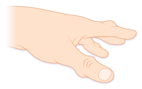 Finger- und Handgelenke sind häufig von einem Gichtanfall betroffen. Sie schmerzen und sind berührungsempfindlich. © Gelenk-Klinik durch Gicht geschwollene Fingergelenke