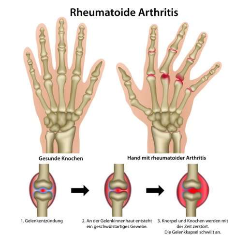 Bei rheumatischer Arthritis kann die Entzündung der Gelenkschleimhaut (Synovialitis) die Fingergelenke schädigen. © bilderzwerg, Fotolia Rheumatoide Arthritis in den Fingergelenken