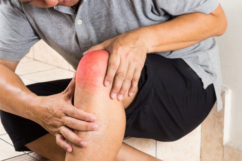 Eine Form der Arthritis ist die bakterielle oder septische Arthritis. Sie betrifft besonders oft das Knie und zeigt sich mit Schmerzen, Rötung und Überwärmung. © stock.adobe.com, ThamKC Foto von einem geröteten, geschwollen Knie