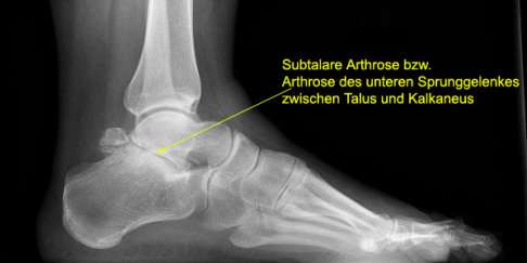 Röntgenbild, seitlich: Sichtbar ist eine Subtalare Arthrose zwischen Talus (Sprungbein) und Kalkaneus (Fersenbein). Charakteristisch ist die Verengung des Gelenkspaltes und die subchondrale Sklerosierung des Knochens (Verdickung der Knochenschicht unterhalb des Knorpels) und Knorpelschwund zwischen Fersenbein und Sprungbein. © Radiopedia.org Röntgenbild Sprunggelenk