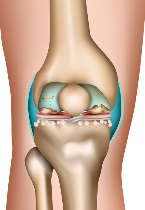 Bei aktivierter Arthrose ist der Gelenkknorpel (hellblau) großflächig zerstört und die darunterliegenden Knochen (braun) reiben direkt aufeinander. Die Folge sind starke Schmerzen, Gelenkschwellung, Rötung und Überwärmung. © bilderzwerg, Adobe Aktivierte Arthrose