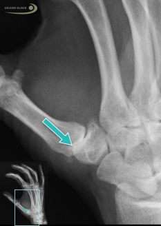 Röntgenbild einer Arthrose des Daumensattelgelenks: Der verschmälerte Gelenkspalt (Pfeil) ist deutlich sichtbar. © Gelenk-Klinik Röntgenbild einer Rhizarthrose