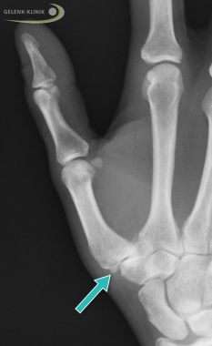 Röntgenbild einer Rhizarthrose: Sichtbar sind die knöchernen Anbauten im Gelenk (Osteophyten, Pfeil) und der deutlich verschmälerte Gelenkspalt. © Gelenk-Klinik Röntgenbild Daumensattelgelenkarthrose mit Osteophyten