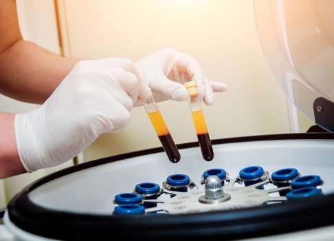 In einer Zentrifuge werden die zellulären Blutbestandteile und das Plasma voneinander getrennt. Die für die Wundheilung und Regeneration notwendigen Thrombozyten können so angereichert und für eine Injektion in das Großzehengrundgelenk vorbereitet werden. © romaset, Fotolia Eigenbluttherapie mit plättchenreichem Plasma