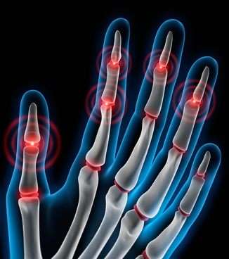 Bei Fingerarthrose können die Fingerendgelenke oder -mittelgelenke schmerzen. © peterschreiber.media, Fotolia Fingerarthrose