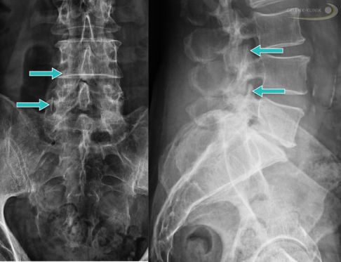 Röntgenbild einer Wirbelsäule mit Spondylarthrose. © Gelenk-Klinik Spondylarthrose im Röntgenbild