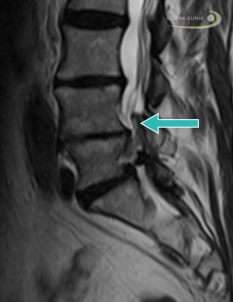 MRT (Magnetresonanztomographie) einer Wirbelsäule mit Spondylarthrose, einer Form der Spondylose. © Gelenk-Klinik Spondylarthrose im MRT