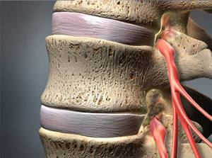 Spinalkanalstenose ist eine Einengung des Nervenkanals in der Wirbelsäule. Sind die Spinalnerven (rot) an ihrer seitlichen Austrittsstelle komprimiert, liegt eine Foramenstenose vor. Schmerzen, Taubheit und Brennen in der vom eingeklemmten Nerven versorgten Körperregion sind die Folge. in schweren Fällen kann es auch zu Lähmungen kommen. © Viewmedica Spinalkanalstenose