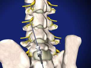 Facettendenervierung: Mithilfe dieser minimalinvasiven Prozedur wird der Schmerz bei Spondylarthrose bekämpft. © Viewmedica Denervierung eines Facettengelenks
