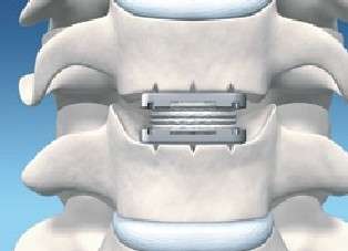 Eine Bandscheibenprothese kann die Bandscheibe des Patienten in der Halswirbelsäule ersetzen. © Spinal Kinetics Zervikale Bandscheibenprothese kann die biologische Bandscheibe ersetzen