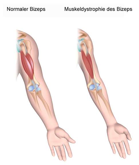 Bei Riss der langen Bizepssehne stellt der Schulterspezialist oft eine Rückbildung des Bizepsmuskels (Muskelatrophie) fest. © Alila Medical Media @ Fotolia Vergleich Bizeps normal und Muskeldystrophie