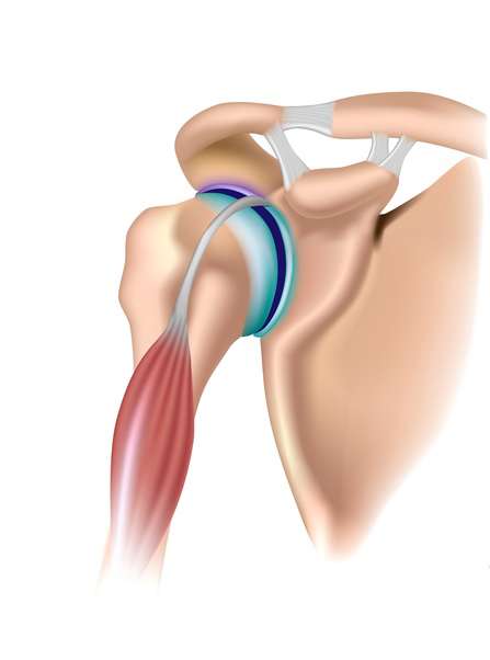 Die lange Bizepssehne verläuft innerhalb des Schultergelenks und ist am oberen Rand der Schulterpfanne (Glenoid) verankert. Fast alle Bizepsverletzungen betreffen diese lange Bizepssehne. © Alila Medical Media @ Fotolia Anatomie der langen Bizepssehne