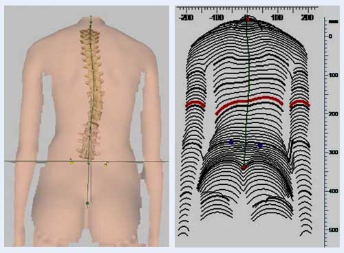 Anhand projizierter Linien erstellt der Rückenspezialist ein Modell der Wirbelsäule des Patienten. Mithilfe des schmerzfreien Verfahrens werden Fehlstellungen und Krümmungen deutlich. © Gelenk-Klinik 3D-Wirbelsäulenmessung beim Patienten