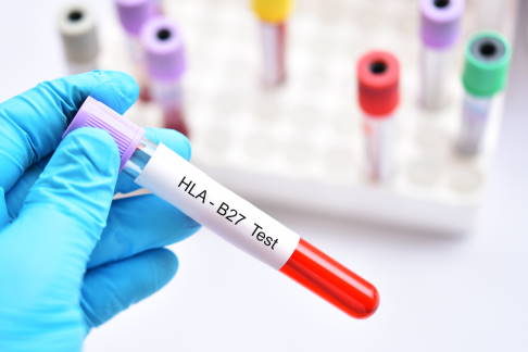 Das genetische Merkmal HLA-B27 wird im Labor aus einer Blutprobe des Patienten bestimmt. Die Untersuchung erfolgt über molekularbiologische oder immunologische Methoden. ©jarun011, Adobe Stock Blutprobe für die labordiagnostische Bestimmung des Genmerkmals HLA-B27