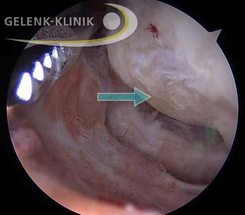Die Arthroskopie des Ellenbogengelenks ist ein minimalinvasiver Eingriff, bei dem der Operateur das Ausmaß des Knorpelabriebs (Pfeil) untersuchen und gleichzeitig behandeln kann. © Gelenk-Klinik Arthroskopie des Ellenbogens