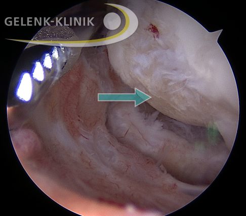 Arthroskopie des Ellenbogens