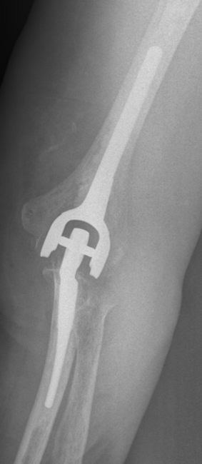 Der Einsatz einer Ellenbogenprothese verhalf diesem Patienten zu schmerzfreier Armbeweglichkeit. © Gelenk-Klinik Prothese bei Ellenbogenarthrose