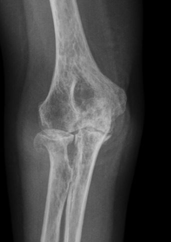 Röntgenbild eines Patienten mit ausgeprägter Ellenbogenarthrose. Der Gelenkspalt mit der schützenden Knorpelschicht zwischen Ober- und Unterarmknochen ist kaum noch sichtbar. © Gelenk-Klinik Ellenbogenarthrose im Röntgenbild