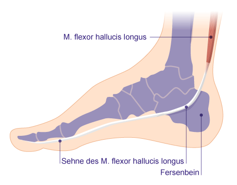Beim endoskopischen Sehnentransfer soll bei geschädigter Achillessehne der M. flexor hallucis longus (Großzehenbeuger) mit seiner Sehne die Beugung im Sprunggelenk übernehmen. Physiologisch verläuft die Großzehenbeugersehne vom Muskelbauch hinunter am Fersenbein vorbei, unter den Fußknochen entlang bis zur Großzehe. © Gelenk-Klinik Anatomie des Fußes mit Großzehenbeugersehne