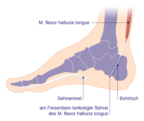 Beim Transfer der Großzehenbeugersehne wird die Sehne durchtrennt, der vom Muskelbauch abgehende Anteil durch ein Bohrloch im Fersenbein gezogen und dort befestigt. Der zur Großzehe verlaufende Sehnenrest verbleibt ohne Funktion im Fuß. © Gelenk-Klinik Darstellung nach Transfer der Großzehenbeugersehne
