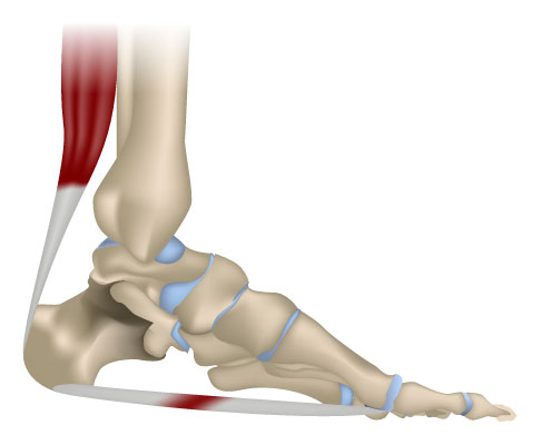 Eine Plantarsehnenentzündung (Plantarfasziitis) kann Fersenschmerzen an der Fußsohle auslösen. © stock.adobe.com/la vector Plantarfasziitis (Plantarsehnenentzündung)