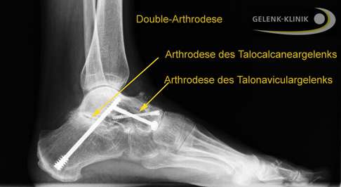 Das talocalcaneare Gelenk (TCG) und das talonaviculare Gelenk (TNG) werden bei einer Double-Arthrodese versteift. © Gelenk-Klinik Röntgenbild des Fußes mit Double-Arthrodese