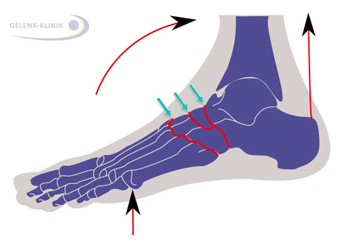 Meistens sind die Gelenke zwischen dem Lisfranc-Gelenk und dem Chopart-Gelenk wegen Fehlbelastung oder Überlastung von einer Fußwurzelarthrose betroffen. © Gelenk-Klinik Meist sind die Gelenke zwischen dem Lisfranc-Gelenk und dem Chopart-Gelenk von Fußwurzelarthrose betroffen.