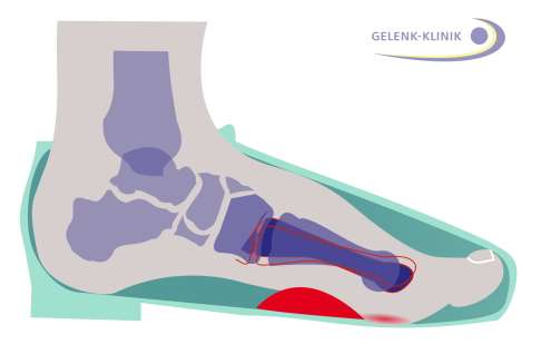 Einlagen (rot) im Schuh (grün) entlasten die metatarsalen Gelenke und können Arthroseschmerzen in der Fußwurzel effektiv vermindern. © Dr. Thomas Schneider Einlagen zur Reduktion von Arthroseschmerzen.