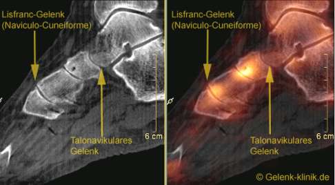 Untersuchung der Fußwurzelarthrose im SPECT-CT: Die Kontrastmittelanreicherungen zeigen deutlich eine erhöhte Stoffwechselaktivität im subchondralen (unter dem Knorpel liegenden) Knochen. Diese Methode kann Arthrosen der Fußwurzeln genauer lokalisieren. © Gelenk-Klinik Untersuchung der Fußwurzelarthrose im SPECT-CT