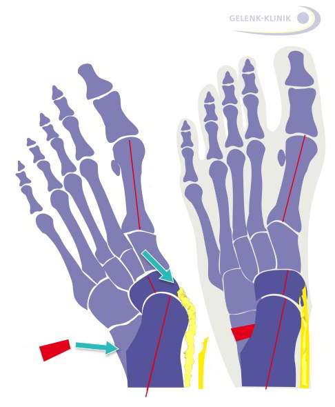Links: Erworbener Knick-Senkfuß mit geschwächter Tibialis-posterior-Sehne (gelb) vor Operation. Diese Sehne ist für die normale Ausprägung des Fußlängsgewölbes mitverantwortlich. Rechts: Knick-Senkfuß nach Operation. Die gestraffte Tibialis-posterior-Sehne und das körpereigene Knochenimplantat richten das Fußgewölbe wieder auf. © Dr. med. Thomas Schneider Knick-Senkfuß vor und nach der Operation