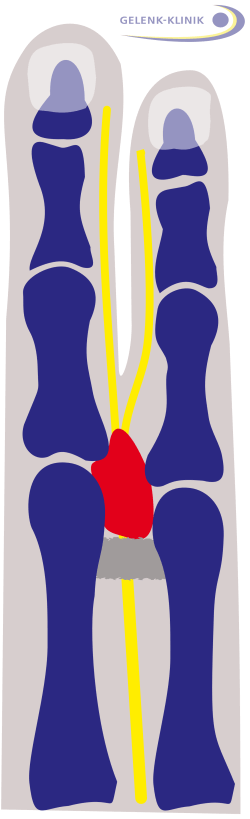 Morton Neurom (rot) als Schwellung zwischen den Mittelfußknochen der Zehen (blau). Wenn der Nerv (gelb) gereizt ist, entwickeln sich in seinem gesamten Versorgungsgebiet brennende oder stechende Mittelfußschmerzen. © Dr. med. Thomas Schneider Morton Neurom